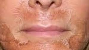 تجربتي مع التقشير الكميائي لتحسين مظهر الوجه و تجديد الخلايا الميتة chemical peel youtube