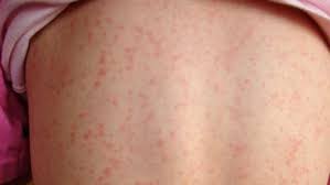 Scarlet Fever Is Back And Parents Need To Watch Out For These Signs And Symptoms Fever Rash Scarlet Fever Rash Strep Throat