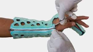 Image result for Ulnar Gutter Cast