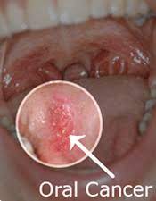 Signs and symptoms of throat/mouth cancer include swollen jaw, hoarseness, and an earache. Oral Cancer Symptoms Causes Treatments 1 800 Dentist