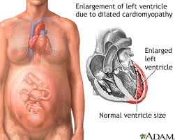 Image result for Cardiomyopathy