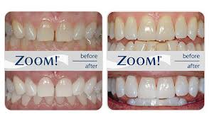 You'll get professional, affordable results with little to no sensitivity. Teeth Whitening In Merced Ca Olive Dental Care Sumeet Pannu Dds