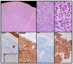 Image result for Merkel Cell Carcinoma