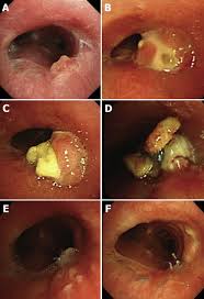 Granulomas form when the immune system attempts to wall off a substance, such as sutures, that it perceives as foreign because it is unable to eliminate it. Intractable Obstructive Endobronchial Granulation Caused By Surgical Materials After Sleeve Resection For Tracheal Carcinoma The Annals Of Thoracic Surgery