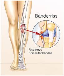 Banderriss Ursachen Symptome Behandlung Medlexi De