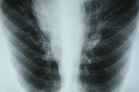 The american cancer society estimates that about 222,500 adults in the united states will receive a lung cancer diagnosis in 2017. Early Signs And Symptoms Of Copd And When To See A Doctor
