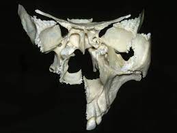 The sphenoid bone (also sphenoidal bone, sphenoid, latin: Anterior View Of Maxilla And Sphenoid Bones Neuroanatomy The Neurosurgical Atlas