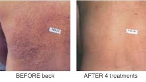 Of course, the hair removal method is the most popular around the world. Ipl Hair Removal