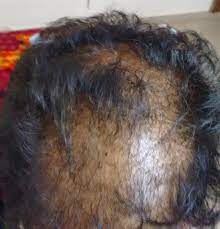 Batra healthcare clinics is one of the best homeopathy hair loss & skin care treatment clinic in india. Dr Batra Hair Loss Treatment Reviewmouthshut