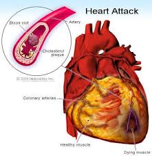 • embolism of malignant tumor cells lies in the tumor metastasis: Heart Attack Causes Symptoms Causes Treatment How To Prevent