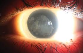 Corneal Abrasion : Eye Trauma : The Eyes Have It