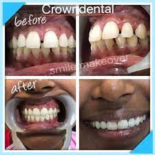 Wandering Dental Crown Princesses Teethwhiteningproduct Dentalcrownprep Dentistas Dentista Dental