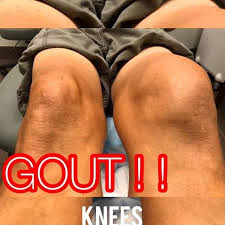 Image result for gout symptoms knee