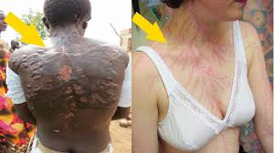 Power, strength, clarity, inspiration, fear and fertility are connected with lightning tattoo designs. People Who Survived Getting Struck By Lightning Show What It Does To Your Skin Youtube