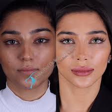 İstanbul aesthetic center is located in istanbul and specializes in plastic surgery. Dr Suleyman Tas Md Aesthetic And Plastic Surgeon In Istanbul Turkey Read 124 Reviews