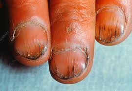 Image result for Koilonychia feet