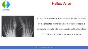 Image result for Hallux Varus