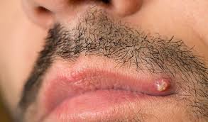 For women, they're more likely to pop up in the. How To Get Rid Of Ingrown Facial Hair Causes Prevention And Removal Beardoholic