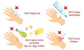 Treating Minor (First Degree) Burns, Blisters And Scalds | Health Plus