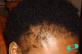 Symptoms include small red or dark bumps around hair follicles, in addition to red and inflamed skin in the surrounding area. while men of all races and ethnicities can suffer from razor bumps, a. 10 Most Common Black Skin Conditions And Their Treatment First Derm