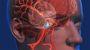 Tac cerebral o craneal desde 85€. Sintomas Del Aneurisma Cerebral Fucac