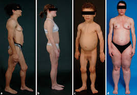 We did not find results for: Lipodystrophie Erkrankungen Springerlink