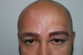 In addition to protecting the eyes, they frame the face and help us to communicate. Eyebrow Transplant Hlc Hairline Clinic