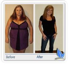 Pin On Sleeve Gastrectomy
