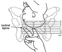 Image result for Bishop Score