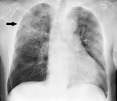 Learn more about pneumonia at webmd. Pneumonia Wikipedia