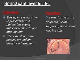 Achieveressays.com is the one place where you find help for all types of assignments. Fixed Prosthodontics Crown Bridge Ppt Video Online Download