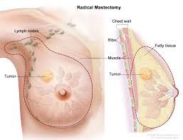 Image result for Mastectomy