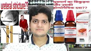 We did not find results for: Urethral Stricture à¤® à¤¤ à¤°à¤® à¤° à¤— à¤¨ à¤¦ Homeopathic Medicine For Urethral Stricture Youtube