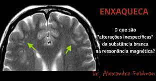 Țesutul colorat cd68 arată câteva macrofage în zona leziunii, la scara originală de 1:100. Ressonancia Magnetica Alteracoes Da Substancia Branca Na Enxaqueca