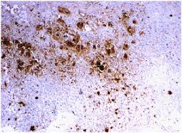 Rgb to hsv color conversion. Immunohistochemistry Stain Is Positive For Hsv 1 And Hsv 2 This Download Scientific Diagram