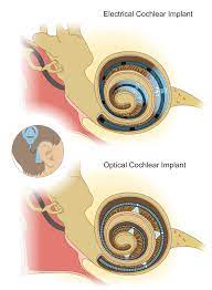 A cochlear implant (ci) is a surgically implanted electronic device that provides a sense of sound to a person who is profoundly deaf or severely hard of hearing. Institute For Auditory Neuroscience Hearing By Light