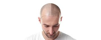 La tecnica microfue è il metodo più avanzato e all'avanguardia di trapianto di capelli. Trapianto Capelli Fue Italia Star Medical Center