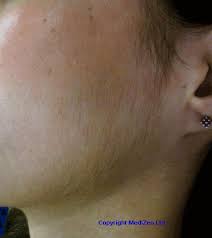 Lolis says it can range depending on which body. Laser Ipl Hair Removal Treatment Cost Side Effects Information