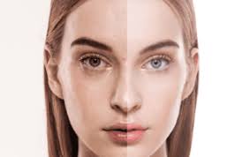 Acne Treatments at Acne Freedom Clinic Mumbai