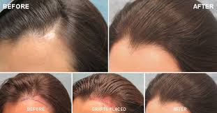 Some forms of hair loss are. Hair Loss In Women Female Hair Loss Bernstein Medical