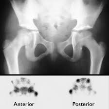 Image result for Osteomyelitis Bone Scan