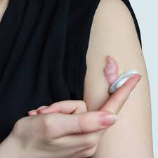 Image result for Keloid