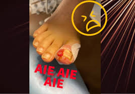 Image result for Onychotillomania feet