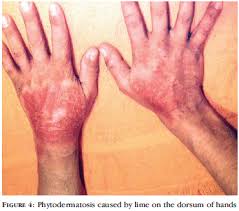 Cacti and other succulents can be kept in a dish garden when small. Dermatosis Due To Plants Phytodermatosis