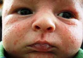 May 26, 2021 · some natural remedies for baby acne that you may want to discuss with baby's doctor include: Home Remedies For Baby Acne You Can Treat And Prevent Pimple Like Bumps On Newborn S Face Naturally Baby Face Rash Baby Acne Remedy Newborn Acne