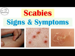 Image result for scabies symptoms