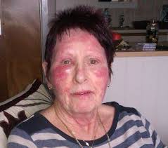 Rinita alergică se dezvoltă atunci când organismul reacționează excesiv la un factor alergen din mediu. Dermatita Alergica Pe Fata Wasatchpremiermovers Com