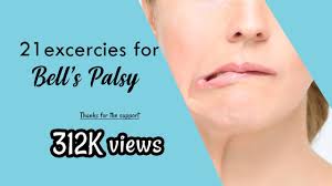 It may develop suddenly, or develop more gradually over a period of 24 to 48 hours. 21 Exercises For Bell S Palsy Do Not Do These During Complete Palsy Initial Days Youtube