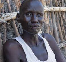 Malnutrition deals a double blow to people with HIV and TB in South Sudan