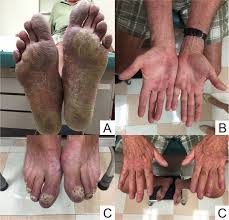Image result for Pustular Psoriasis
